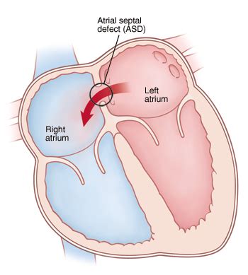 Treatment for Your Child’s Atrial Septal Defect (ASD)