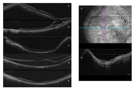 Myopic Retinal Degeneration: Observations with OCT - mivision