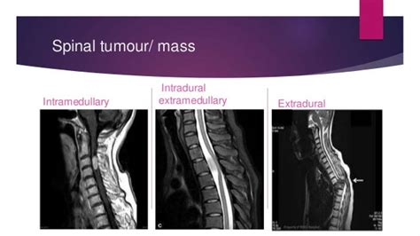 Intradural extramedullary mass - a case on MRI