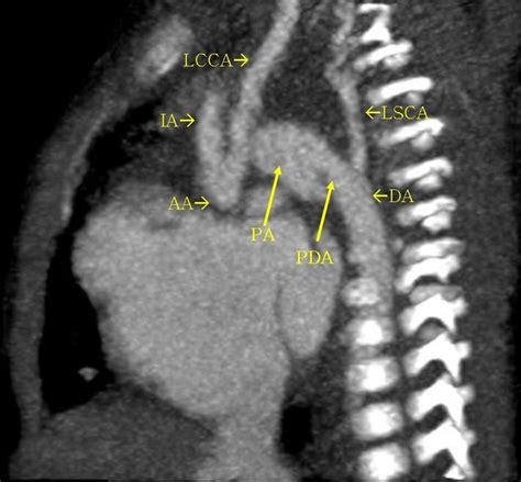 Interrupted Aortic Arch - radRounds Radiology Network