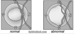 Evaluating the cup and disc in glaucoma - EyeGuru