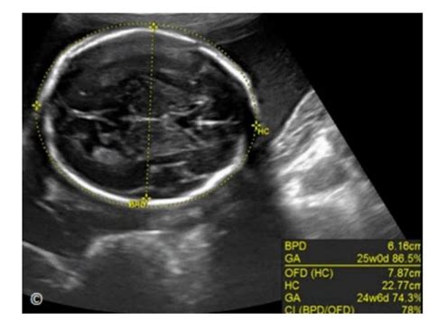 8. normal second trimester ultrasound