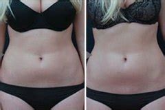 Vanquish Cincinnati - Fat Removal Cincinnati