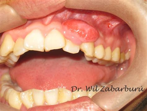 CLINICA DENTAL ASISTENCIAL: GRANULOMA PIÓGENO