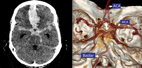 Huge subarachnoid haemorrhage - CT angio - Radiology at St. Vincent's ...