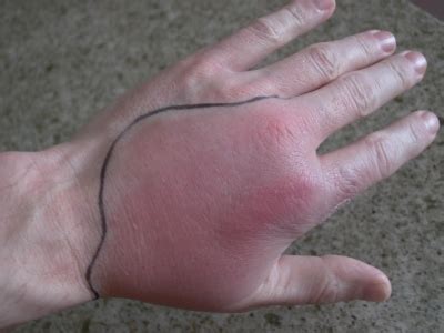 What Cellulitis Looks Like and How to Treat It