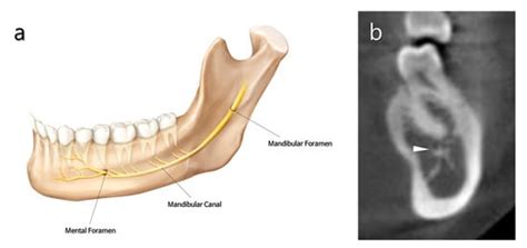 Endodontic Microsurgery of Mandibular Molars | Encyclopedia MDPI