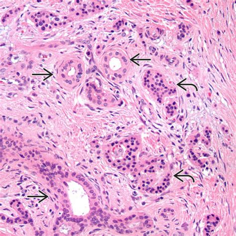 Chronic Pancreatitis | Basicmedical Key