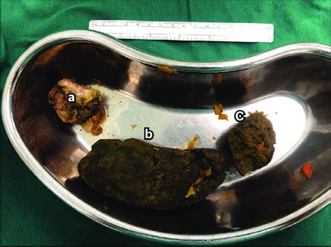 Photograph shows gross specimens of a 5-cm phytobezoar obstruction in... | Download Scientific ...