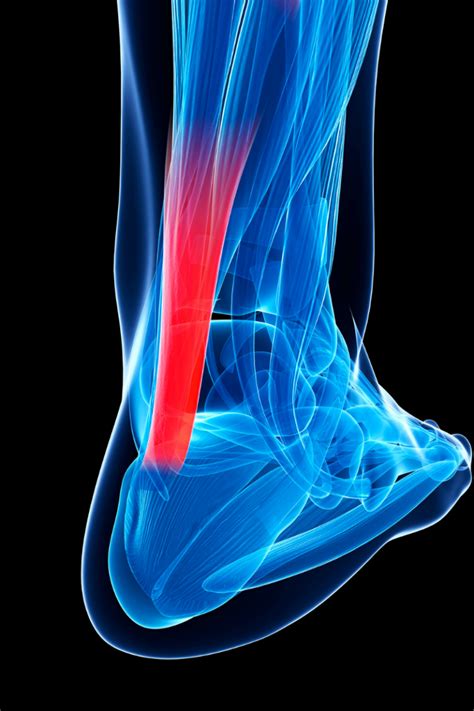 Achilles Tendon Pathology - Vitality Physiotherapy