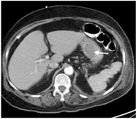 Computed tomography scan showing a gastric leiomyoma (arrow) protruding... | Download Scientific ...