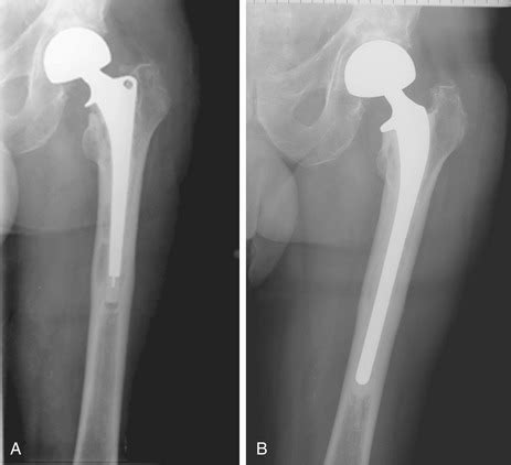 Periprosthetic Infection | Plastic Surgery Key