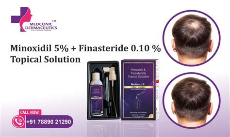 Minoxidil Finasteride Topical Solution: Uses, Results, Side Effects