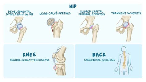 Pediatric orthopedic conditions: Clinical: Video | Osmosis