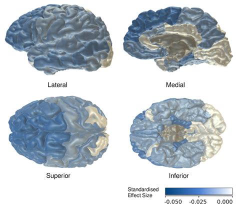 Heatmap illustration of lower cortical thickness in individual brain... | Download Scientific ...