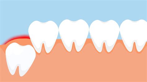 5 Complications That May Arise After Wisdom Tooth Removal | OnlyMyHealth