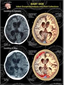 Encephalomalacia Symptoms, Definition, Prognosis, Treatment