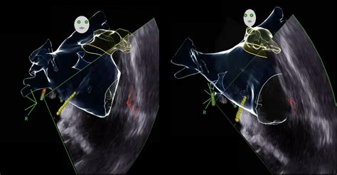 Left Atrial Appendage Occlusion with Intracardiac Echocardiography and ...