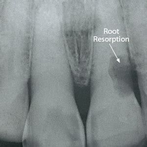 X-ray of Tooth Resorption