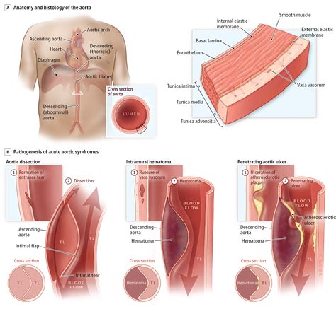 Acute Aortic Dissection and Intramural Hematoma: A Systematic Review | Cardiology | JAMA | JAMA ...