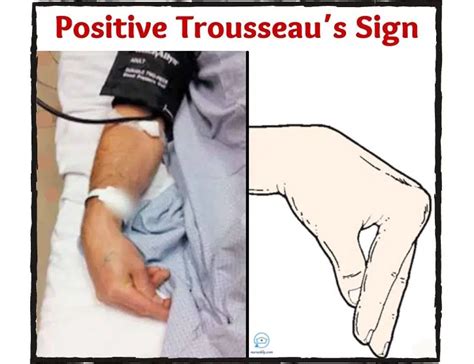 Trousseau's Sign |Causes |Assessment |Treatment - Nurseship.com