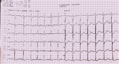 Acute myocarditis presenting as accelerated junctional rhythm in Graves ...