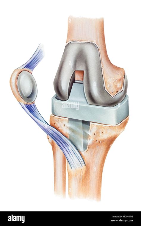 Illustration of a total knee replacement, showing a patellar prosthesis, a cross section of the ...