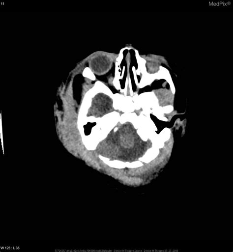 Subgaleal Hemorrhage Ct Scan In Babies