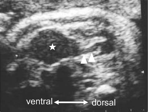 Figure 1 from Novel ultrasound finding of a fetus with Hirschsprung's disease: A caliber change ...