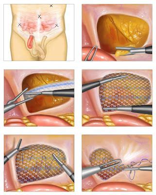 The Health Hub: Inguinal Hernia Repair - Overview | Hernia repair, Abdominal hernia, Hernia inguinal