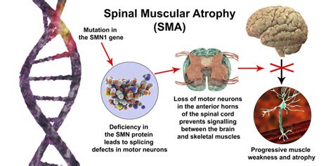 What is SMA Disease (Spinal Muscular Atrophy)? - Plastic surgery in Istanbul