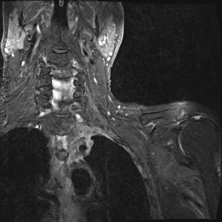 Pancoast tumor - invasive | Radiology Case | Radiopaedia.org