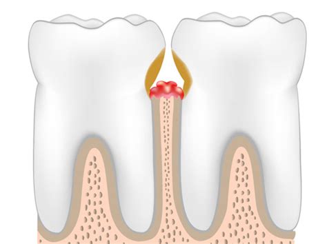 POCKET REDUCTION SURGERY - Prestige Periodontics