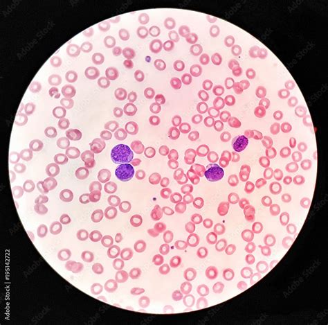 Human blood smear under 100X light microscope with blast cells and normal red blood cells ...