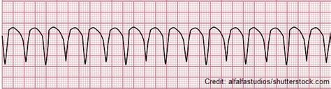 Ventricular Tachycardia (V-tach) ECG/EKG Review Nursing