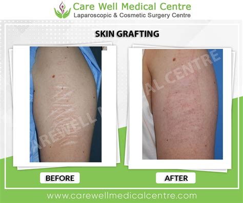 Treatments Before & After Results Gallery | Care Well Medical Centre