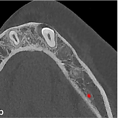 -(a-c) The position of the impacted canine inside the mandibular bone ...