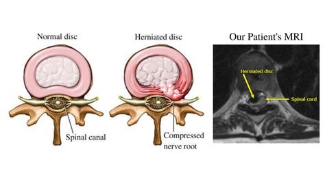 Herniated Disc Extrusion - Ilyas Munshi, M.D.