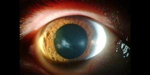 Diagnose This: Complication during penetrating keratoplasty - American ...