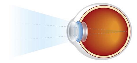 What is Scintillating Scotoma - Definition, Symptoms, Causes, Treatment - Health Care Tips and ...