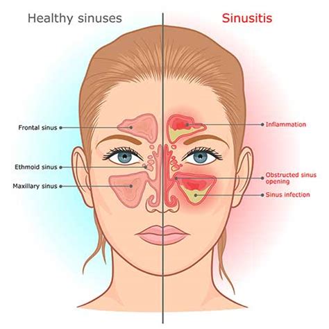 Sinus Infection Swollen Face