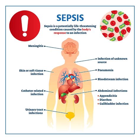 Sepsis Symptoms, Causes, Diagnosis & Treatment