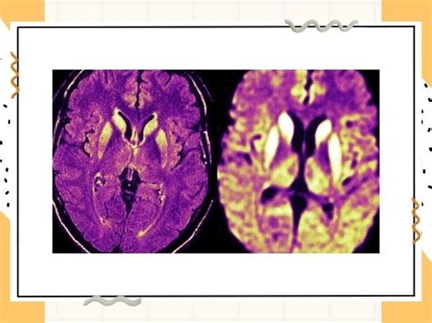 Prion Disease: Symptoms, Causes, Types, & Treatment - Dr Deepak Agrawal