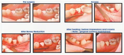 Crown Lengthening - Chow Periodontics