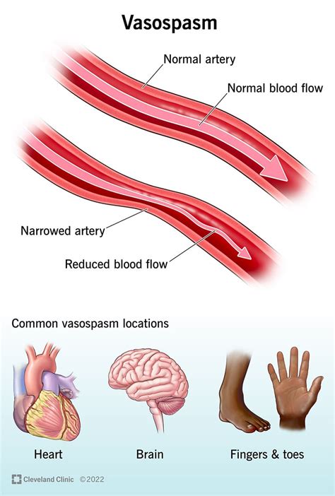 Vasospasm: Types, Causes & Symptoms