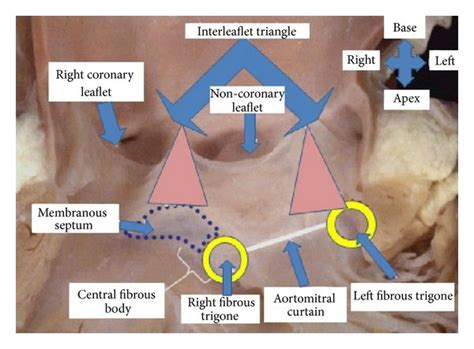 The anatomy of aortic valve, aortic root, coronary arteries orifice ...