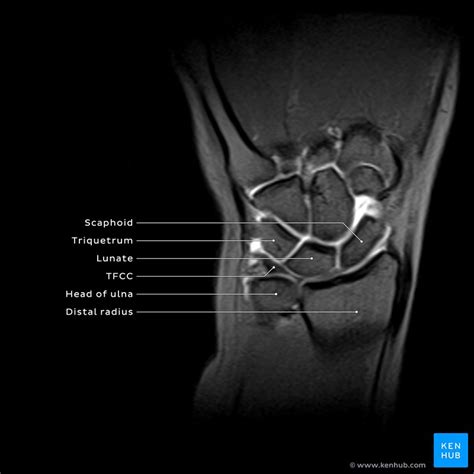 Ischemic contracture: Causes, presentation, treatment | Kenhub