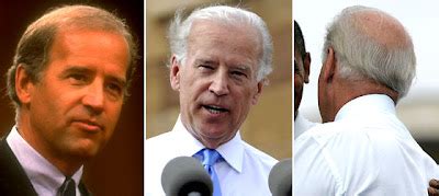 Joe Biden Hair Transplant - Pix n Pix