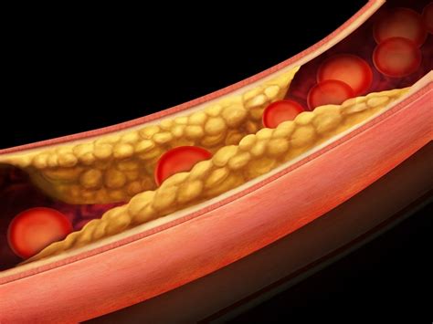 Hyperlipidemia: Bad for the Heart, Good for the Brain?