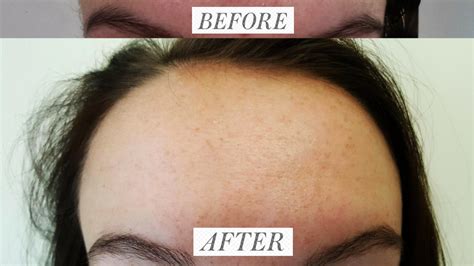 Spironolactone Clears Woman’s Acne in 4 Months: Before and After Photos - Allure